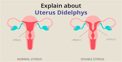 2 vaginas|Uterus didelphys